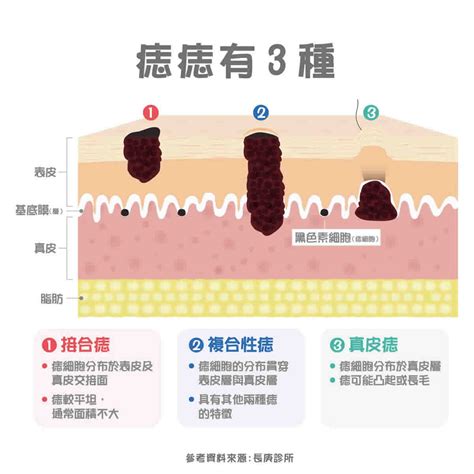 長毛痣|痣變大、痣多或長毛會變皮膚癌？認識痣的形成與原因